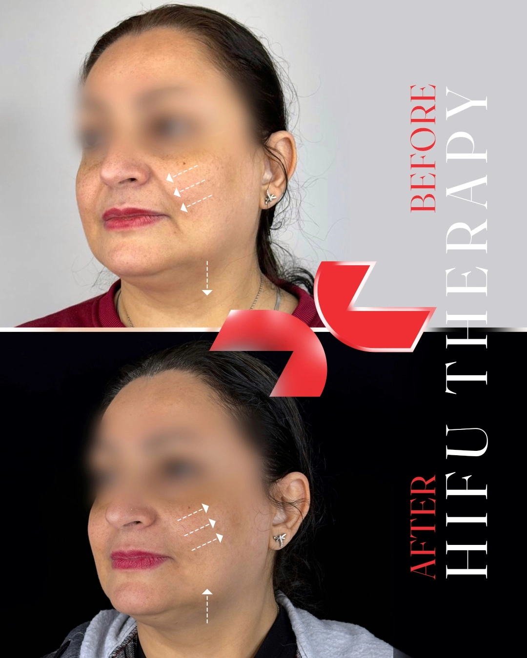 لیفت تخصصی صورت