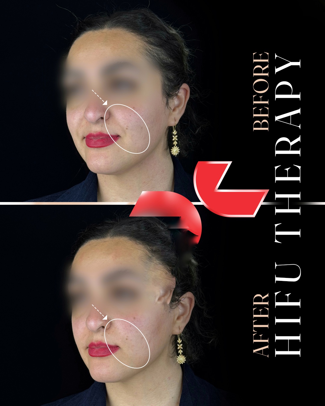 لیفت تخصصی صورت