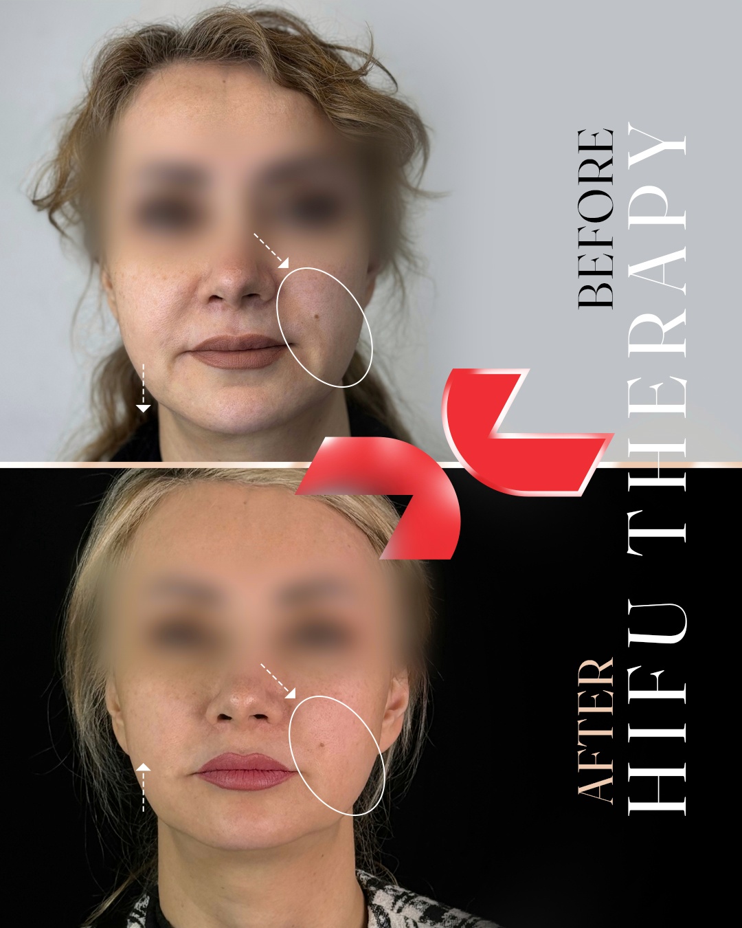 لیفت تخصصی صورت