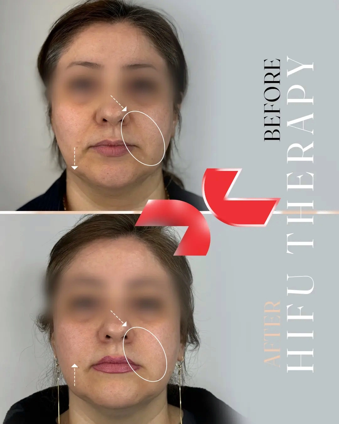 لیفت تخصصی صورت