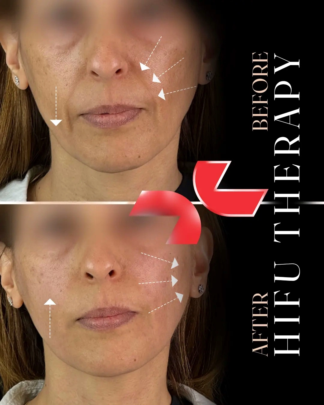 لیفت تخصصی صورت