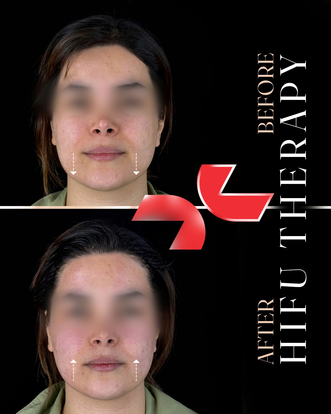 لیفت تخصصی صورت