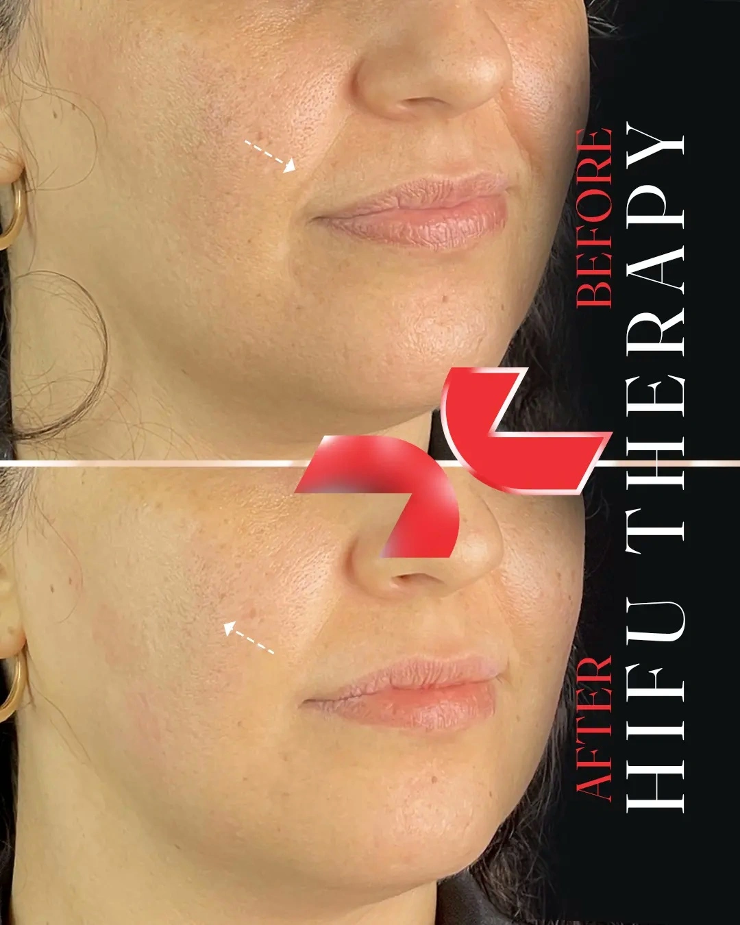 لیفت تخصصی صورت