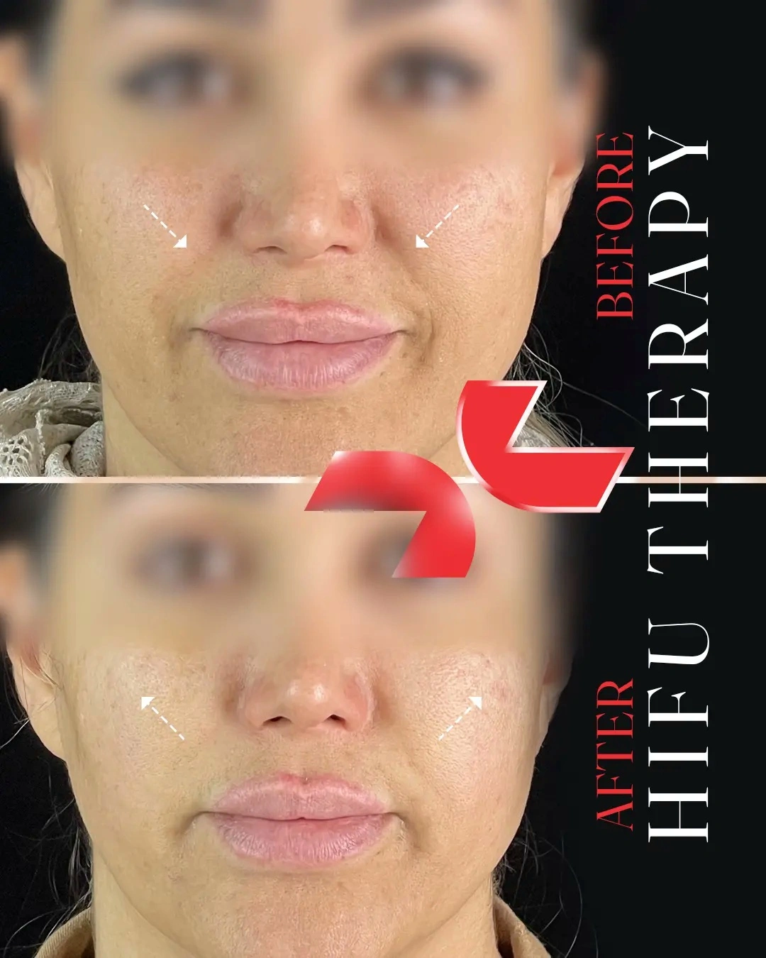 لیفت تخصصی صورت