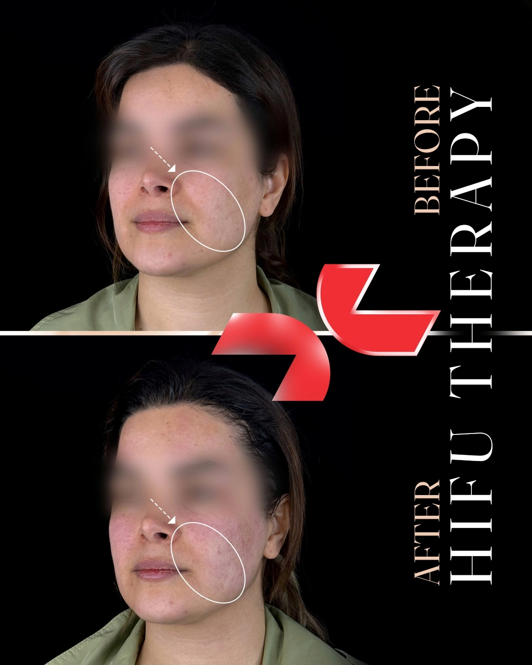 لیفت تخصصی صورت